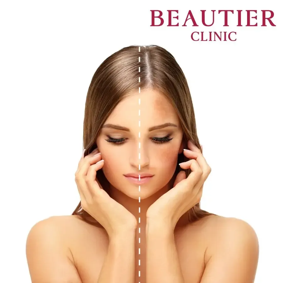 ภาพโปรแกรมดูแลฝ้าสูตรเฉพาะ 4 ขั้นตอนของ Beautier Clinic