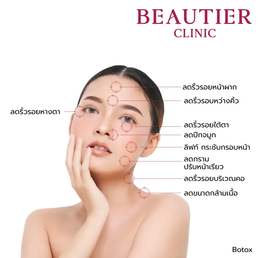 ภาพแสดงตำแหน่งบนใบหน้าที่อาจประเมินสำหรับ Botulinum Toxin ได้แก่ หน้าผาก รอบตา จมูก และกรอบหน้า